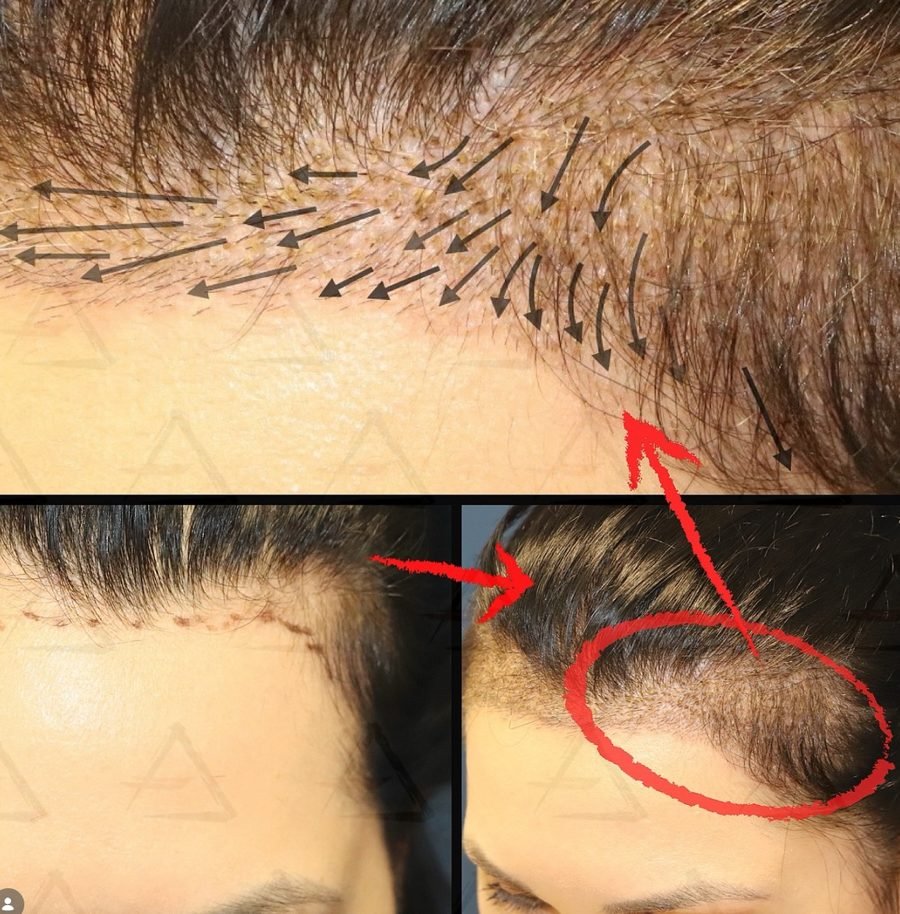 Planejamento técnico de hairline em caso real