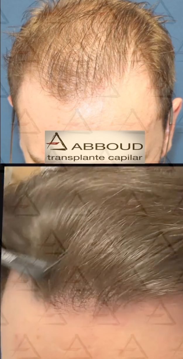 Resultado real de hairline - antes e depois
