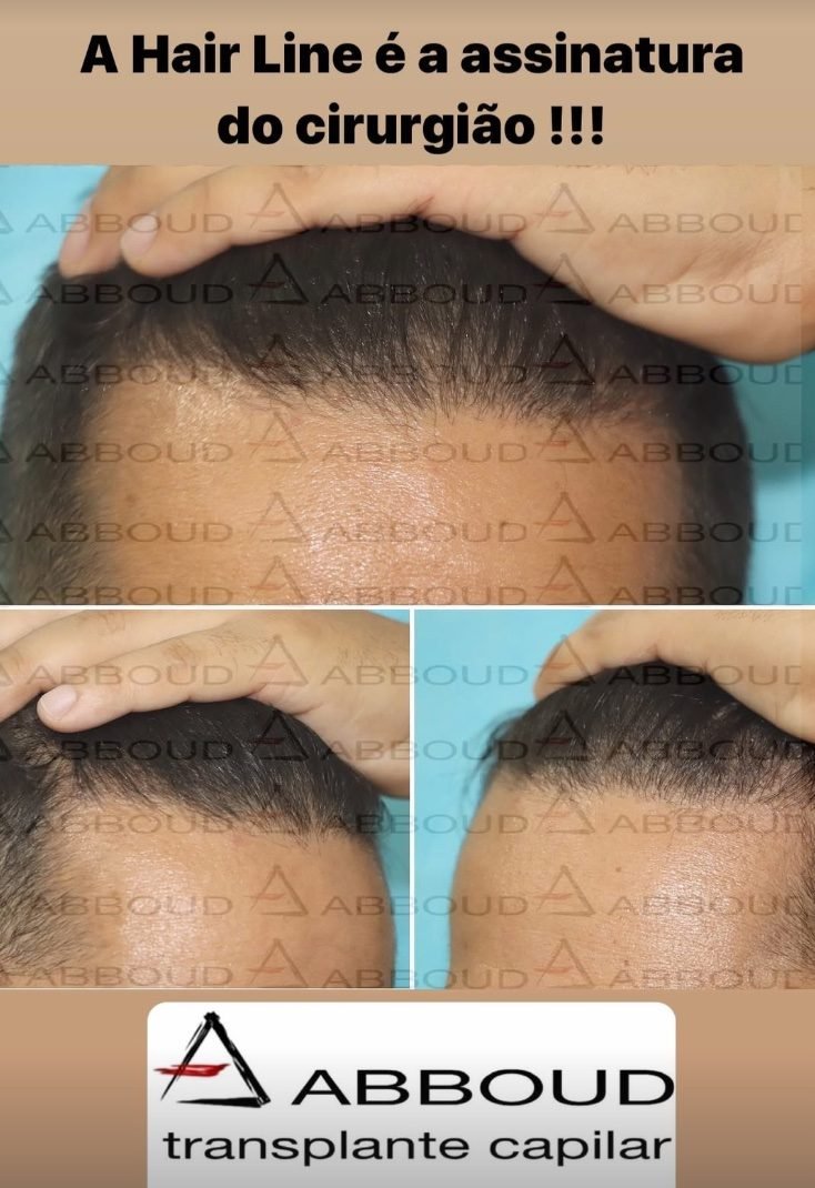 Resultado real de restauração de hairline