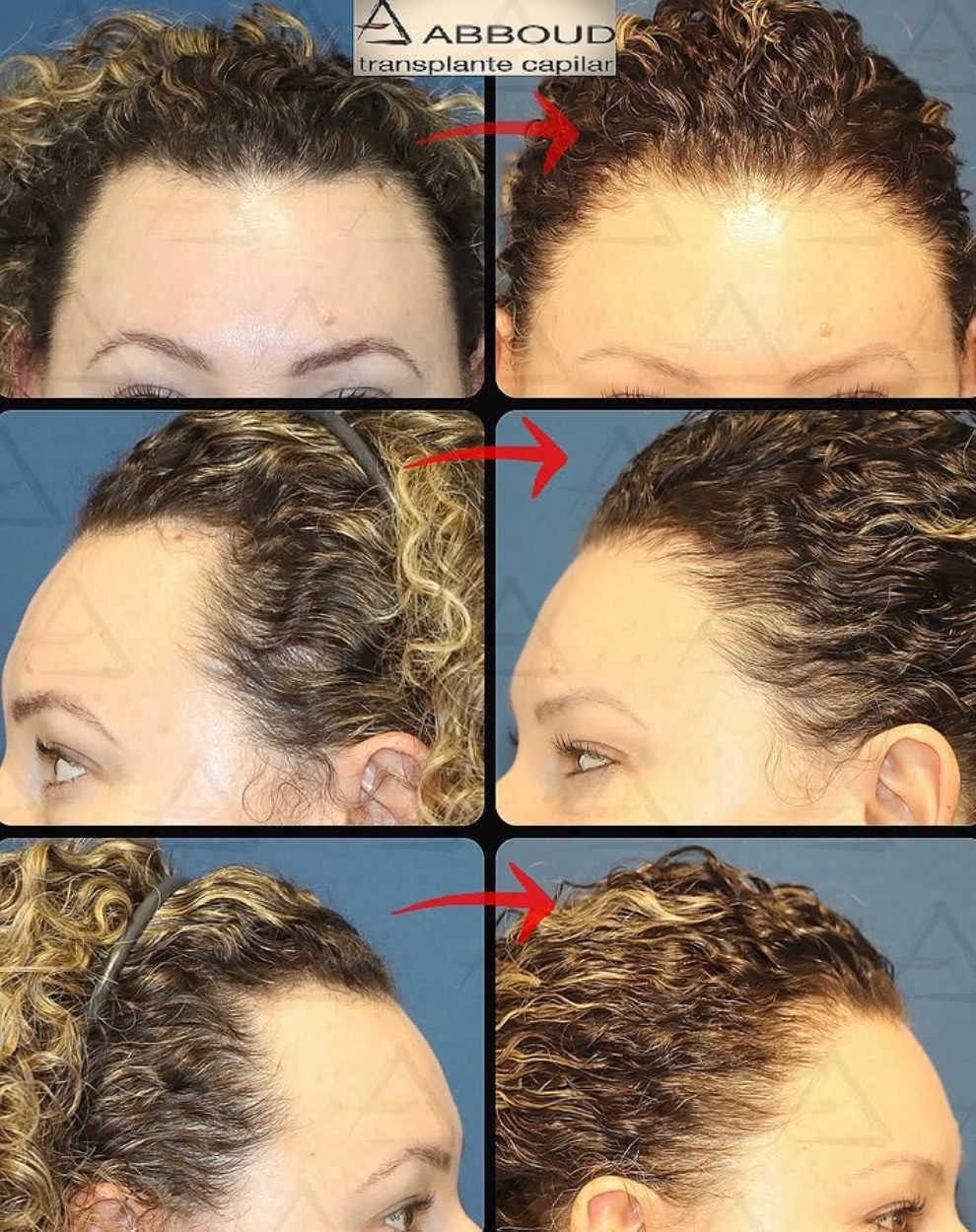 Resultado real em paciente feminina